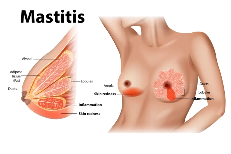 Mastitis