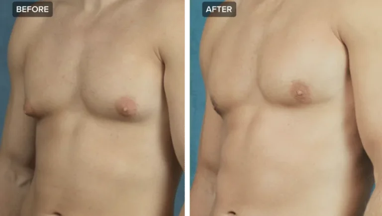 Gynecomastia: Before and After